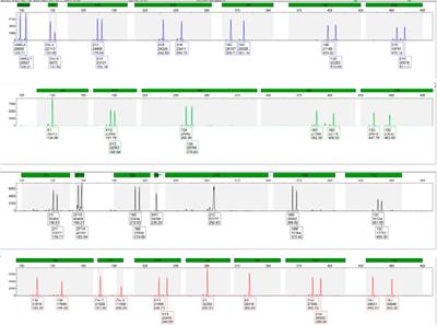 Challenging diagnoses of tetraploidy/diploidy and trisomy 12: utility of first-tier prenatal testing methods